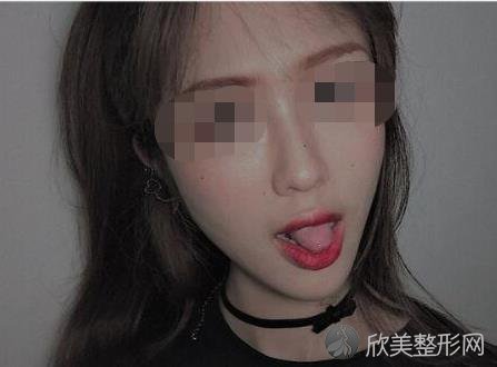 杭州群英整形美容医院做隆鼻之后
