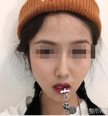 杭州群英整形美容医院做隆鼻之后