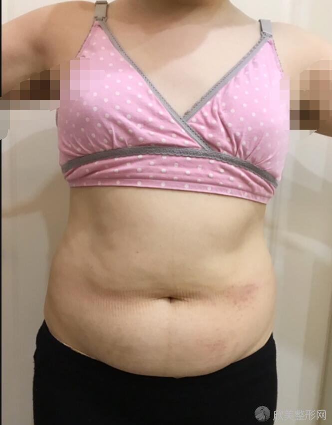 腰腹吸脂术前
