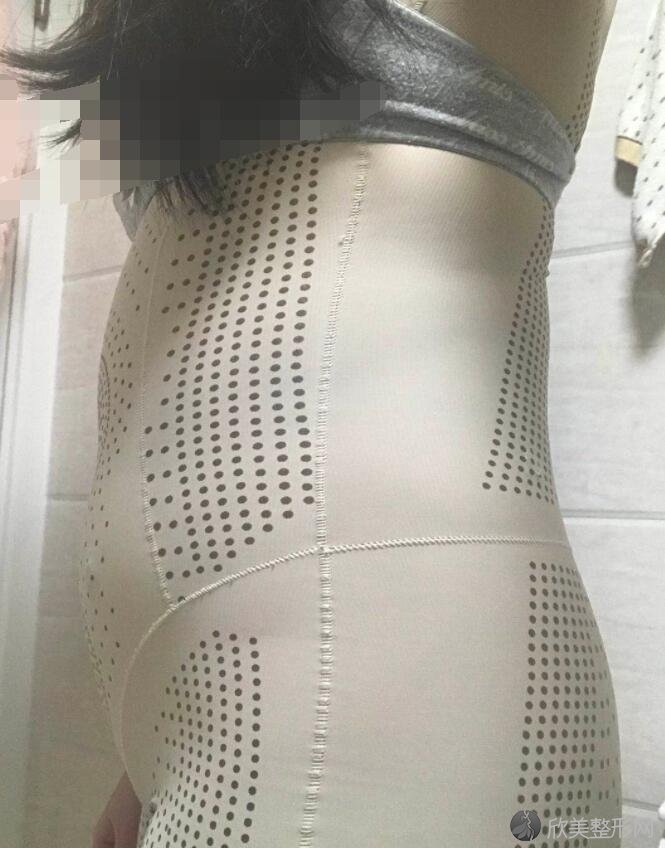 腰腹吸脂术后10天