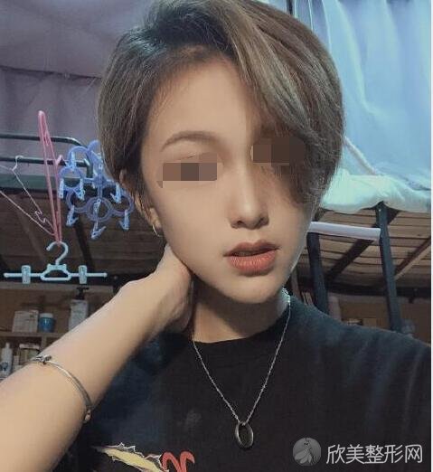 面部吸脂术后20天