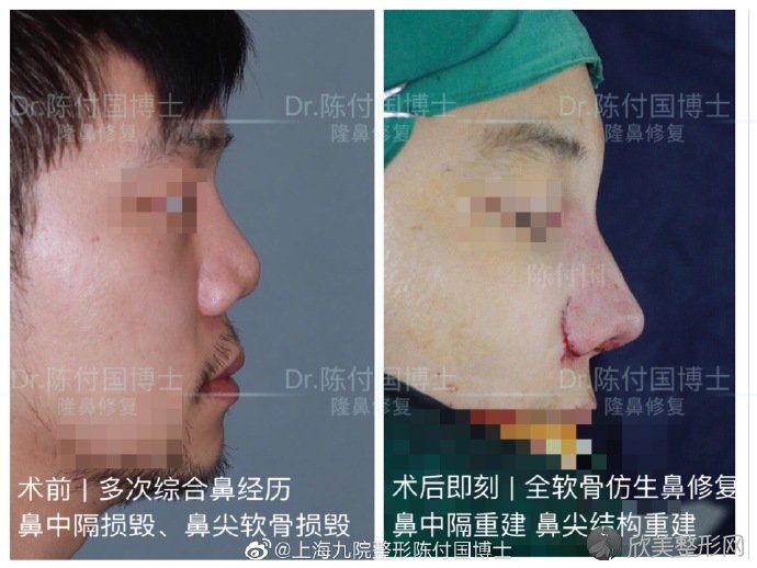 中国很难预约十大隆鼻专家