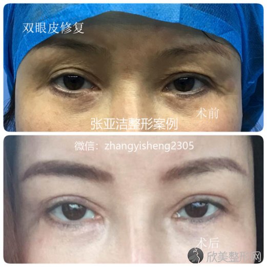 北京张亚洁医生做双眼皮技术好不好？