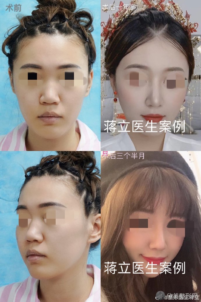 21年西安鼻综合的医生排名 欣美整形 21年西安鼻综合的医生排名 欣美整形