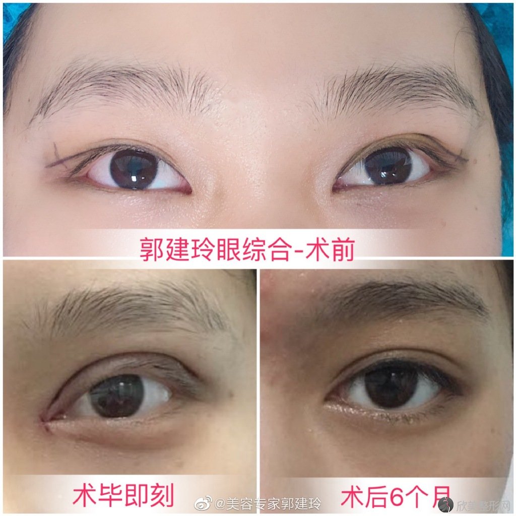 北京有名的双眼皮医生有哪些？