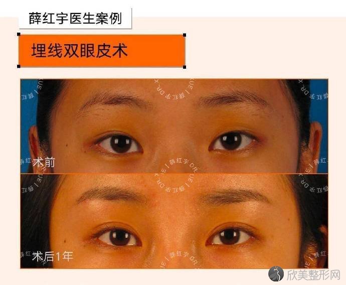 北京有名的双眼皮医生有哪些？