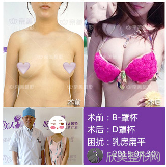 北京自体脂肪丰胸专家哪个较厉害？梁耀婵和刘成胜哪个好？