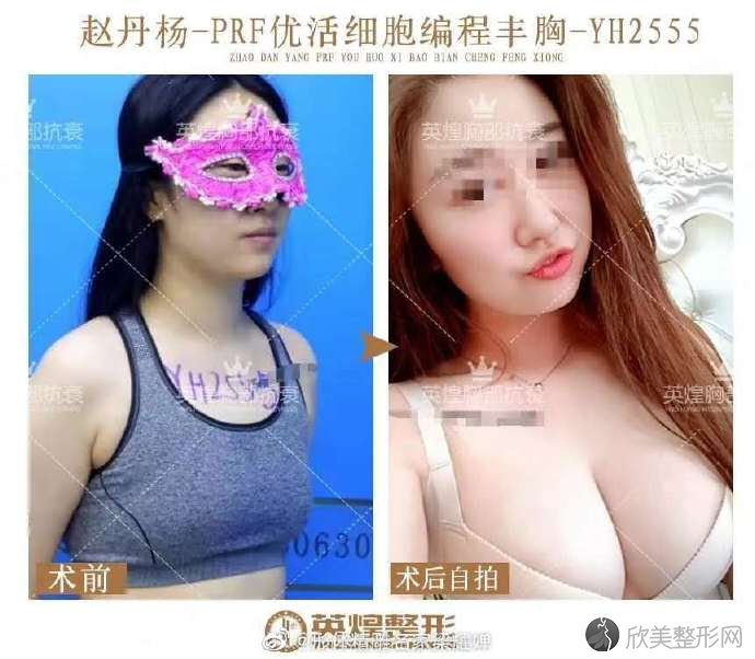 北京自体脂肪丰胸专家哪个较厉害？梁耀婵和刘成胜哪个好？