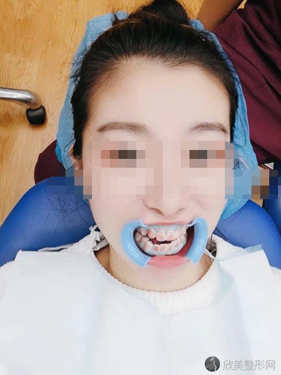 中山大学附属口腔医院东院做牙齿美白过程