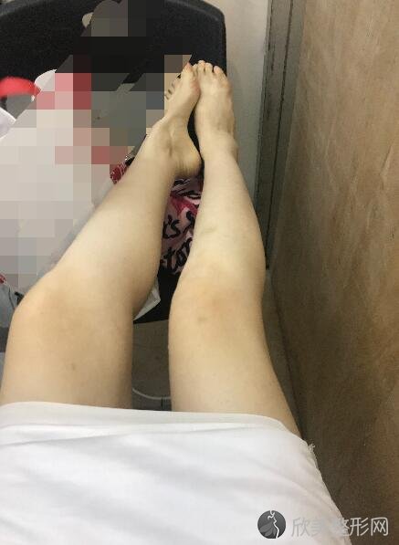 大腿吸脂术后20天