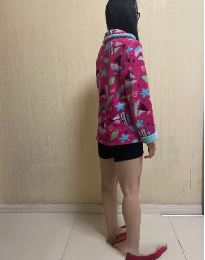 北京金燕子医疗美容诊所做大腿吸脂真人案例展示