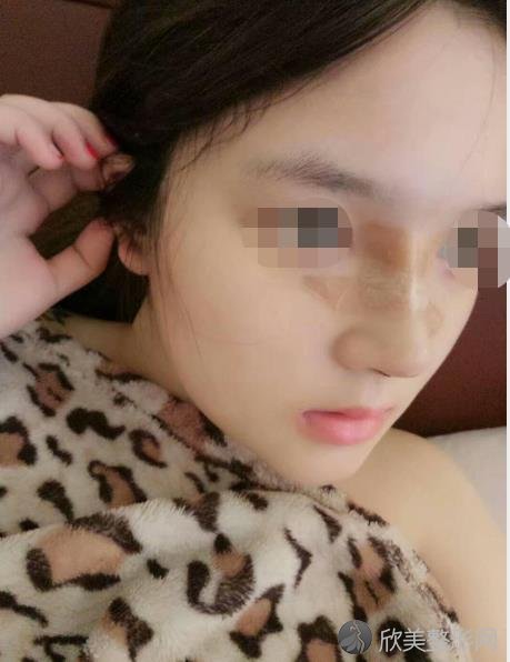 杭州静港整形做隆鼻之前