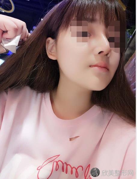 杭州静港整形做隆鼻之后