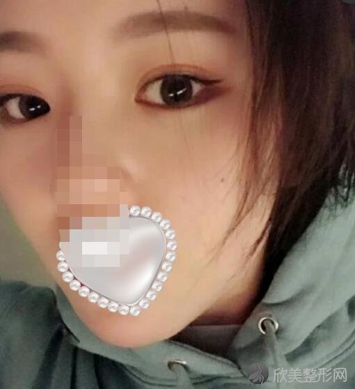 杭州丽脂医疗美容做面部吸脂之后