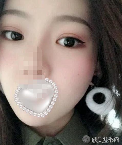 杭州丽脂医疗美容做面部吸脂之后