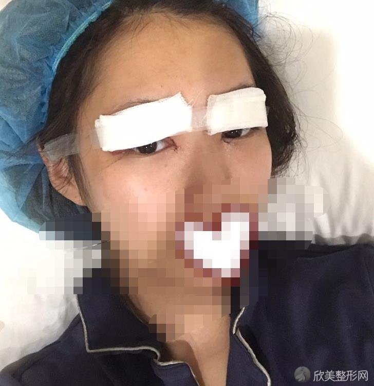 杭州美莱整形医院双眼皮恢复期