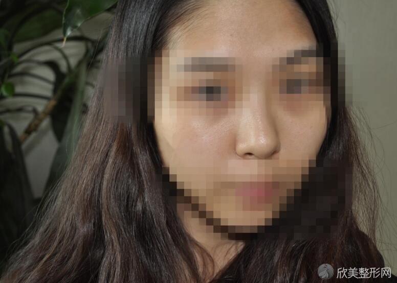 杭州华颜医美怎么样 内附隆鼻整形亲身过程分享 欣美整形网 杭州华颜医美怎么样 内附隆鼻整形亲身过程分享 欣美整形网