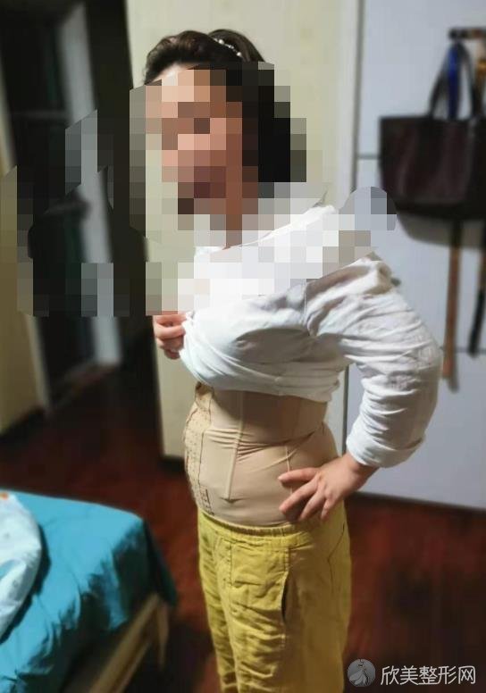 杭州群英整形怎么样靠谱吗？来看看腰腹吸脂的案例吧
