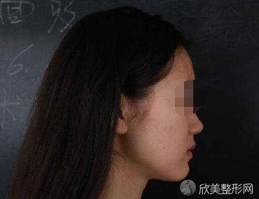 杭州星博体整形医院抽脂之前