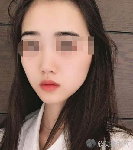 杭州星博体整形医院抽脂之后