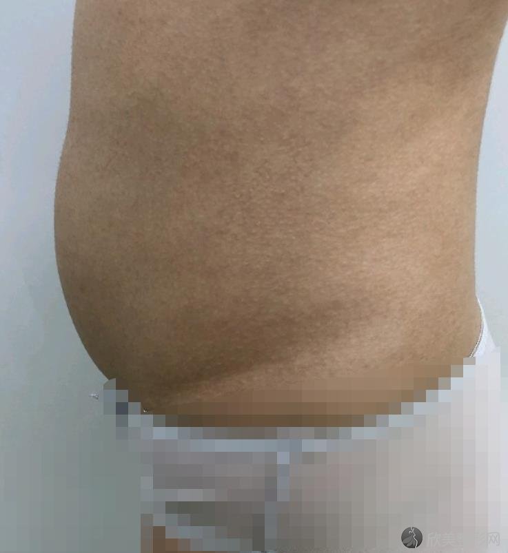 杭州颜粉吸脂之前