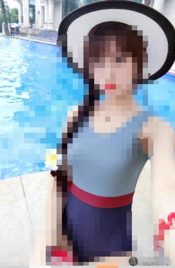 杭州颜粉吸脂之后