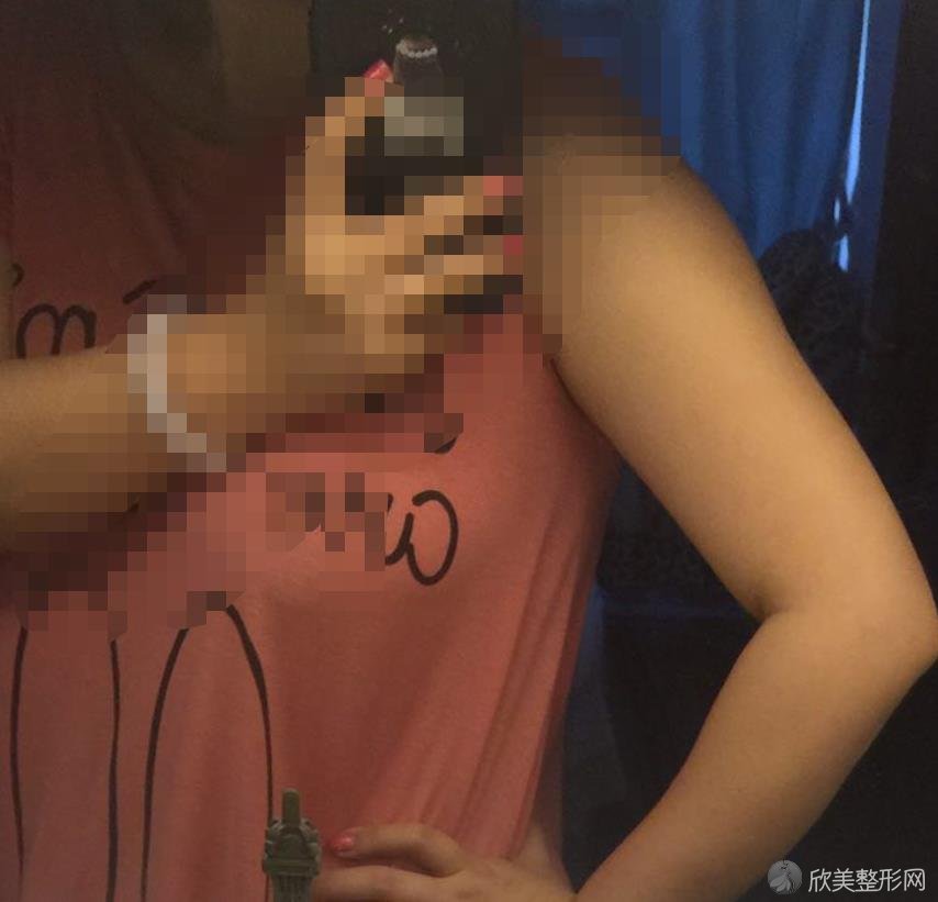 杭州甄美整形吸脂之前