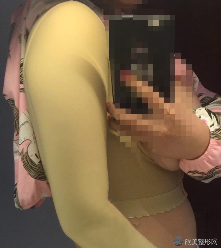 杭州甄美整形吸脂之后