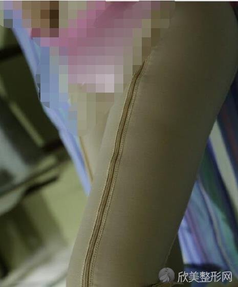 杭州鹏爱医疗整形医院大腿吸脂之后