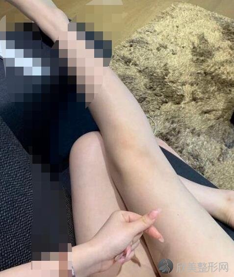 杭州鹏爱医疗整形医院大腿吸脂之后