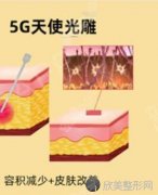 5g天使光雕吸脂术好吗？有哪些优点？