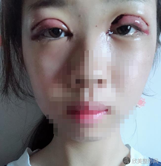 北京金燕子医疗美容医院双眼皮修复