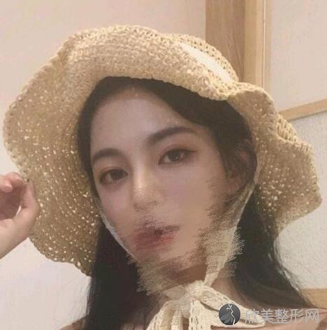 双眼皮术后30天