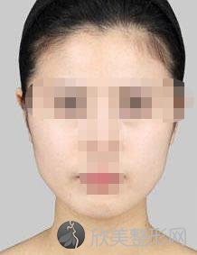 赵绛波下颌角技术怎么样?附真实案例图