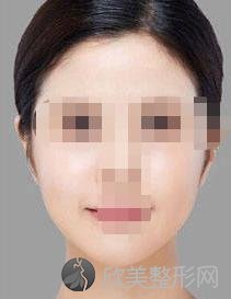 赵绛波下颌角技术怎么样?附真实案例图