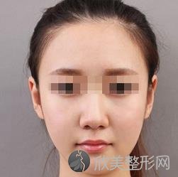 赵绛波下颌角技术怎么样?附真实案例图
