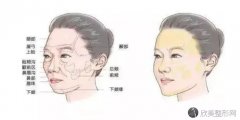 注射玻尿酸的危害大不大？有哪些？