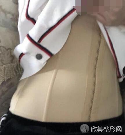 腰腹吸脂术后20天