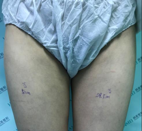 大腿抽脂后的疤痕照片，附大腿抽脂成功案例！