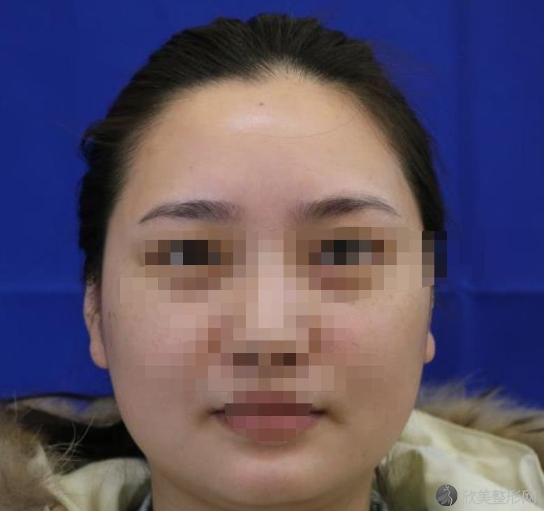 烟台毓璜顶医院做面部吸脂之前