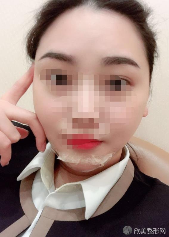 烟台毓璜顶医院做面部吸脂之后