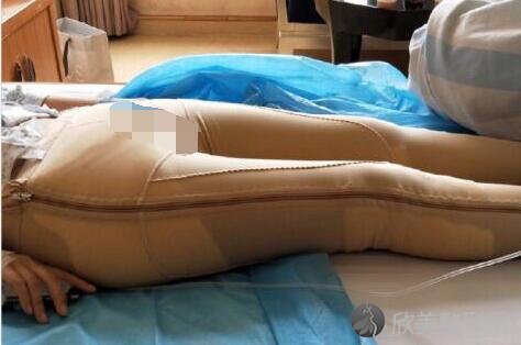 大腿吸脂术后5天