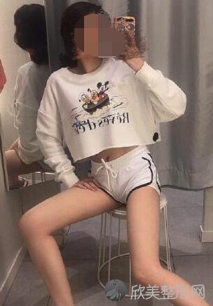 大腿吸脂术后30天