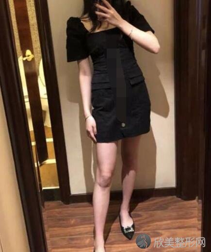 腰腹吸脂术后20天