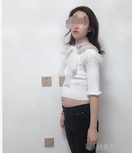腰腹吸脂术前