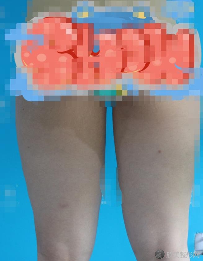 长沙安吉娜整形医院的赵福德医生做腿部吸脂之前