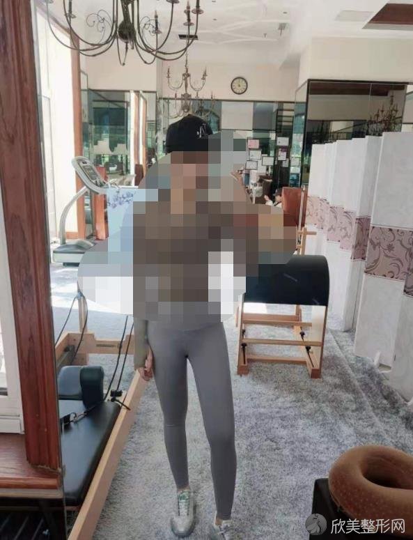 长沙安吉娜整形医院的赵福德医生做腿部吸脂之后