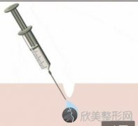 打玻尿酸的价格是多少？