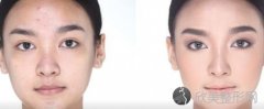 玻尿酸填充脸颊怎么样？效果如何？