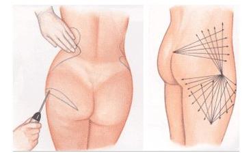 臀部吸脂手术图片，附臀部吸脂手术案例分享！